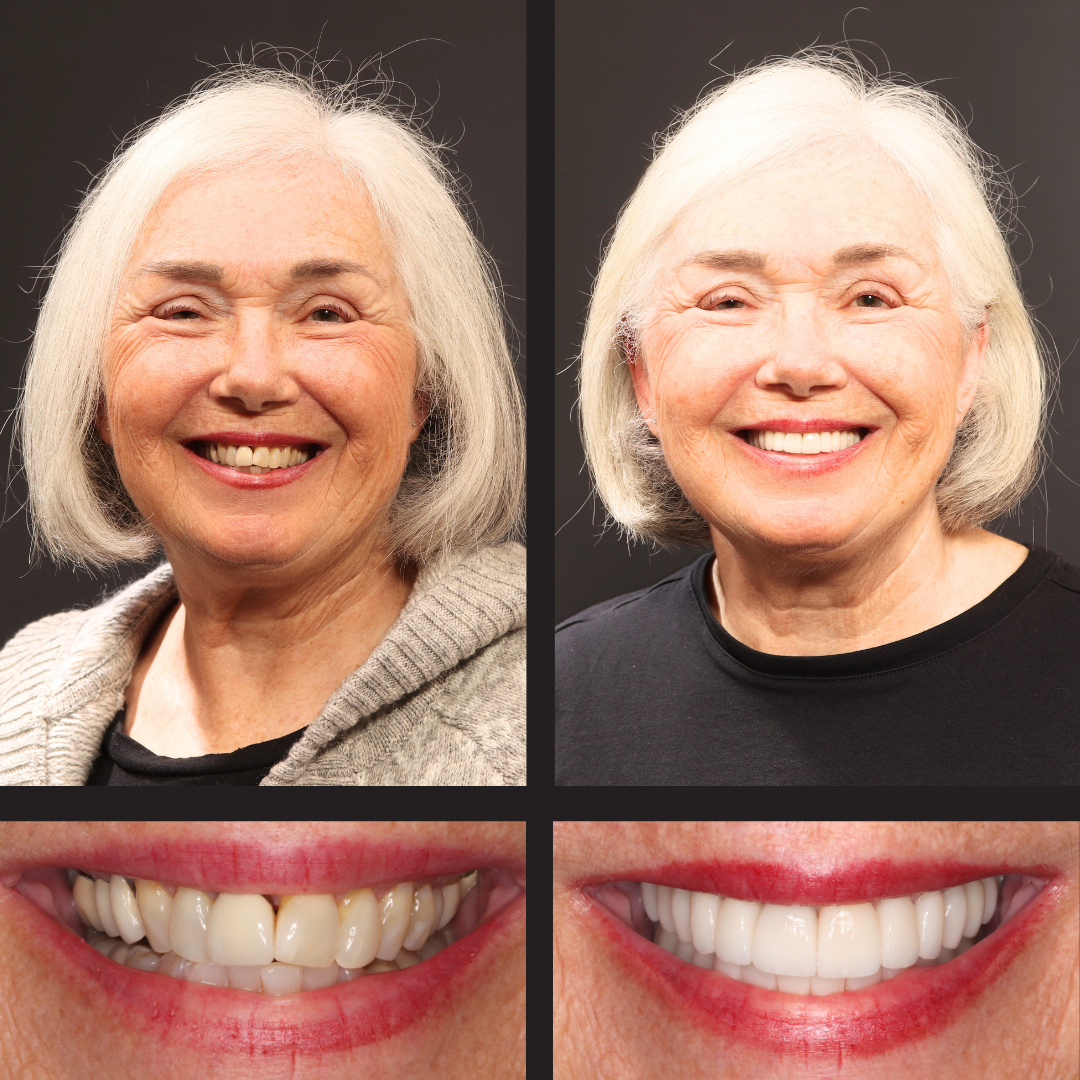 Two-photo collage of an elderly woman smiling: left portrait before dental work, right portrait after cosmetic treatment; top row full-face, with short gray hair. Bottom row shows close-ups of the smile: left natural teeth, right bright veneers.