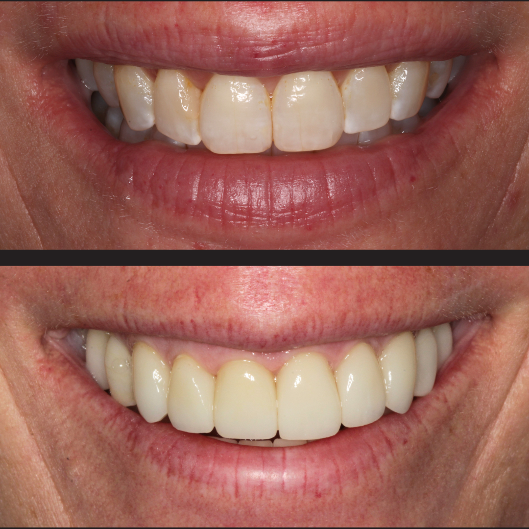 Marcia - Rochester Advanced Dentistry - Rochester Advanced Dentistry - Rochester Advanced Dentistry Two-panel comparison: top shows crowded, yellowed front teeth; bottom shows evenly aligned, white teeth after cosmetic dental work.