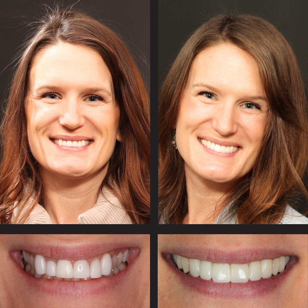 Monica - Rochester Advanced Dentistry - Rochester Advanced Dentistry - Rochester Advanced Dentistry Side-by-side photo showing a woman before and after dental whitening, highlighting a brighter smile.