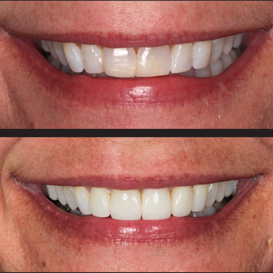 Nichole - Rochester Advanced Dentistry - Rochester Advanced Dentistry - Rochester Advanced Dentistry Before and after close-up of a smile; top shows yellowed, chipped front teeth, bottom shows white, straight teeth after treatment.
