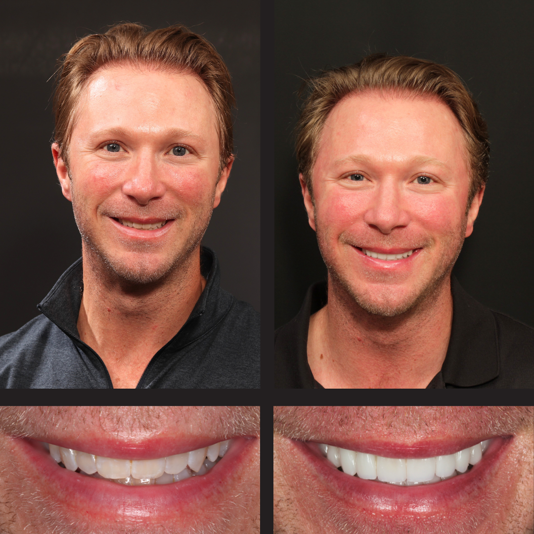 Comparison collage of a man's smile before and after dental whitening: left column shows the person before, right column after; bottom row close-ups of the teeth before (left) and after (right).