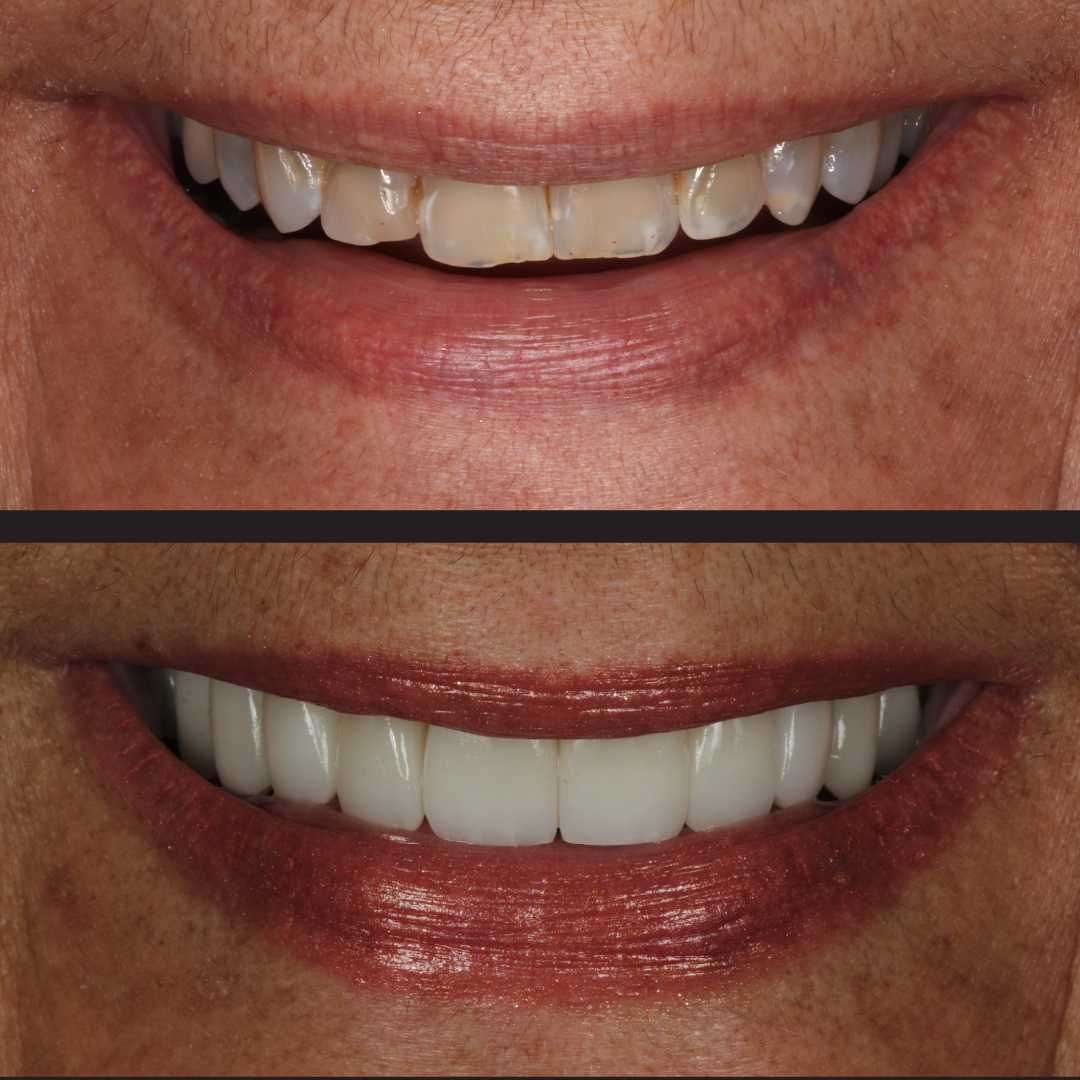 Before-and-after dental whitening: top image shows stained teeth, bottom image shows bright white teeth after treatment.