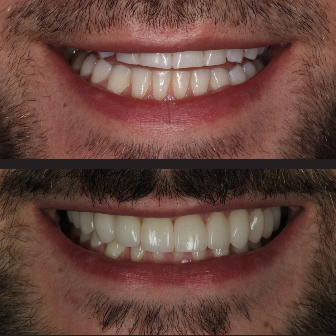Before and after dental makeover: top image shows a crowded, yellowish smile; bottom image shows a straight, white smile after treatment.