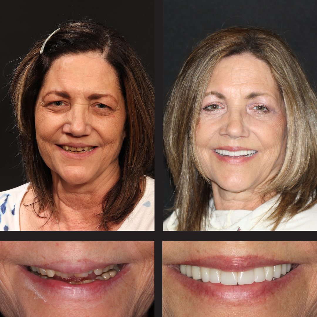 Composite before-and-after collage: left shows a woman with missing teeth, right shows a woman with a full white smile; bottom row close-ups of teeth before and after treatment.