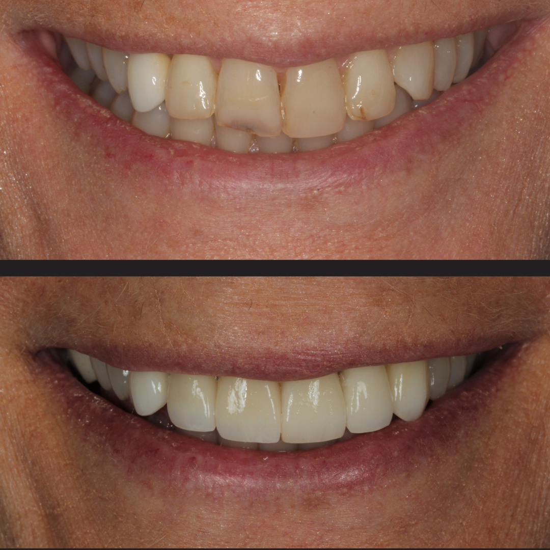 Before-and-after dental makeover: top row shows stained, uneven teeth; bottom row shows uniform, white veneers after treatment.