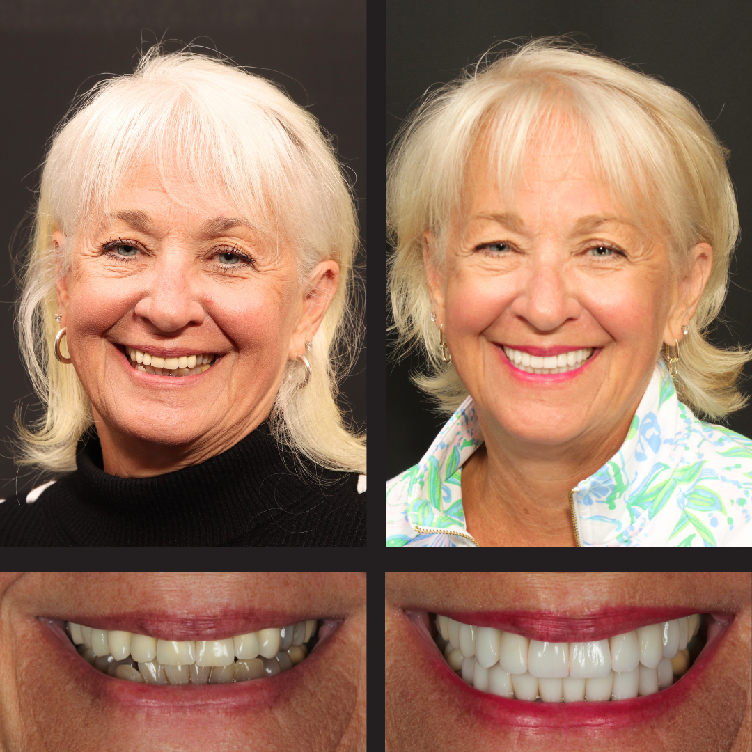 Collage showing a woman before and after cosmetic dental whitening: top row face portraits, bottom row close-ups of teeth before and after.