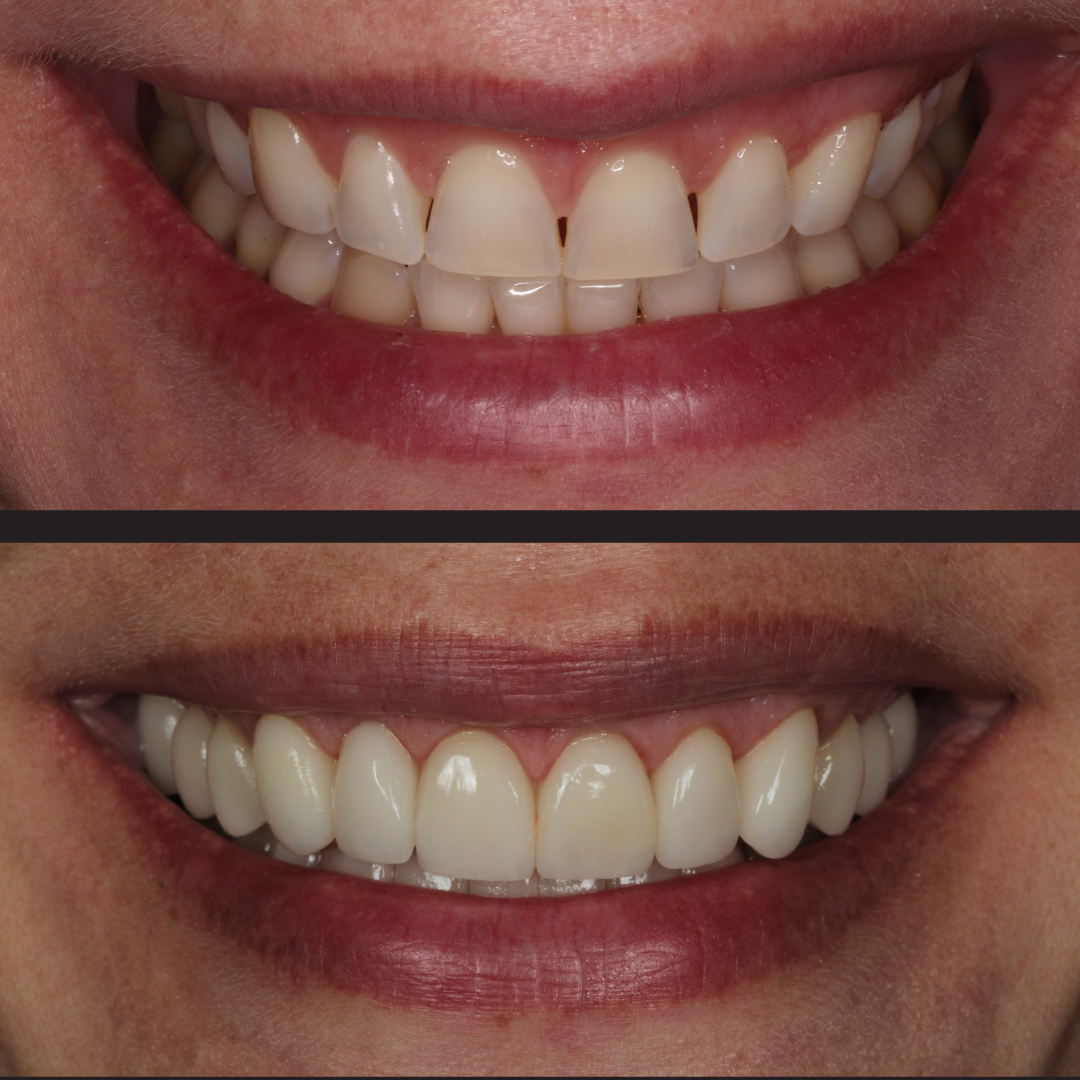 Dental transformation: top image shows crowded, uneven front teeth; bottom image shows straight, white veneers after treatment.