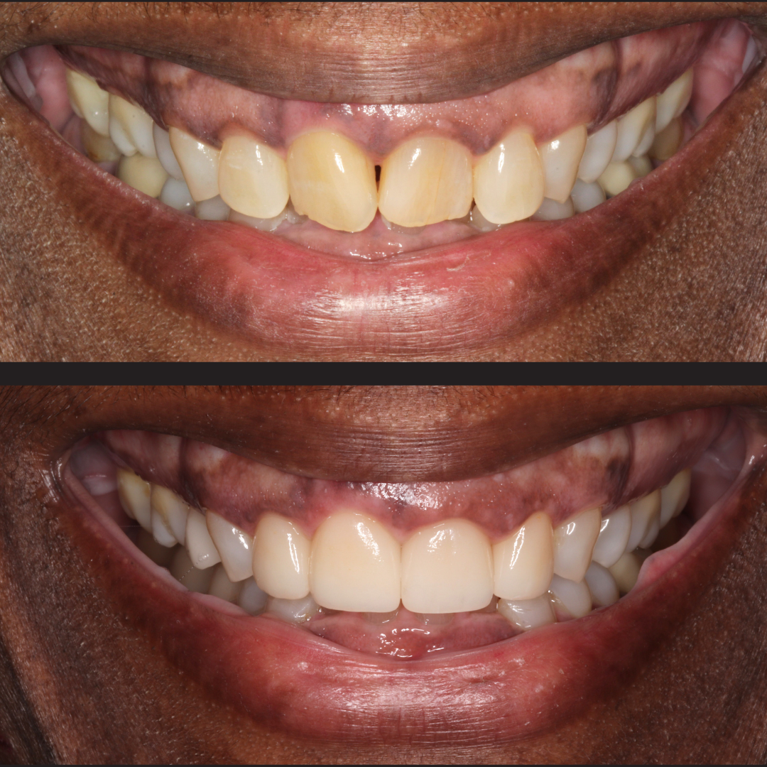 Renita - Rochester Advanced Dentistry - Rochester Advanced Dentistry - Rochester Advanced Dentistry Two-panel before-and-after dental makeover: first image shows crowded, yellowed teeth with gaps; second image shows straight, evenly spaced, whiter teeth with healthier gums.