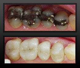 metal free fillings