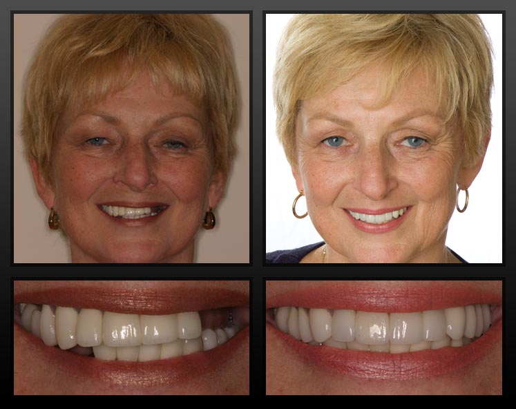 Rochester Implant Dentistry | Questions about Dental Implants
