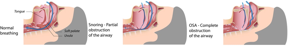 Sleep Apnea Diagram