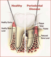 periodontal disease chart