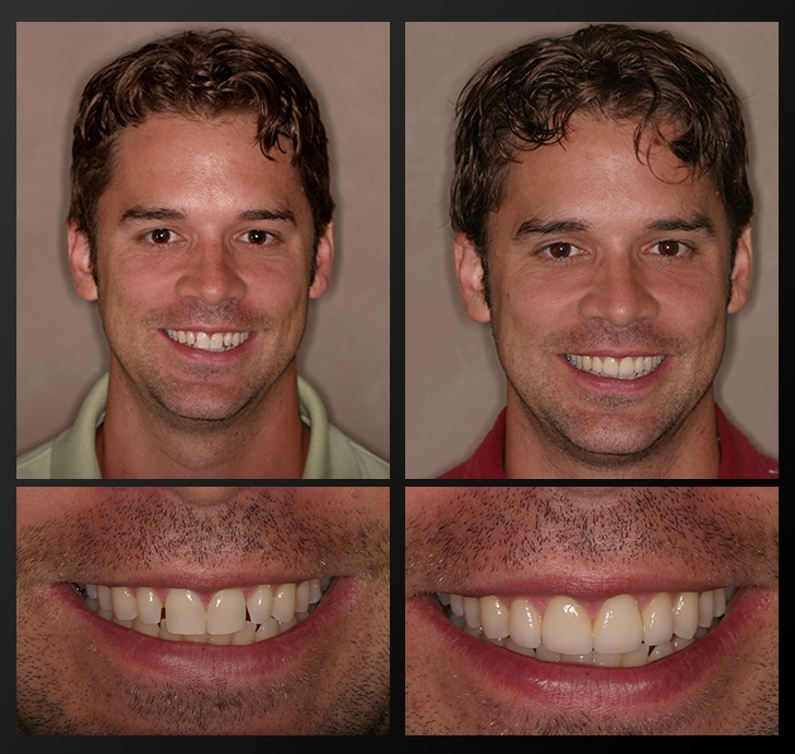 Smile Gallery Before And After Dental Photos Smile Makeovers Images 