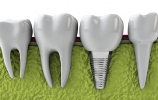 Digital illustration of a dental implant next to regular teeth