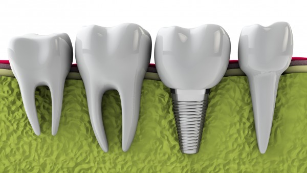 illustration of a dental implant next to natural teeth in gums