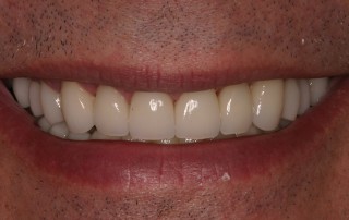 Close up of patient's smile after dental treatment