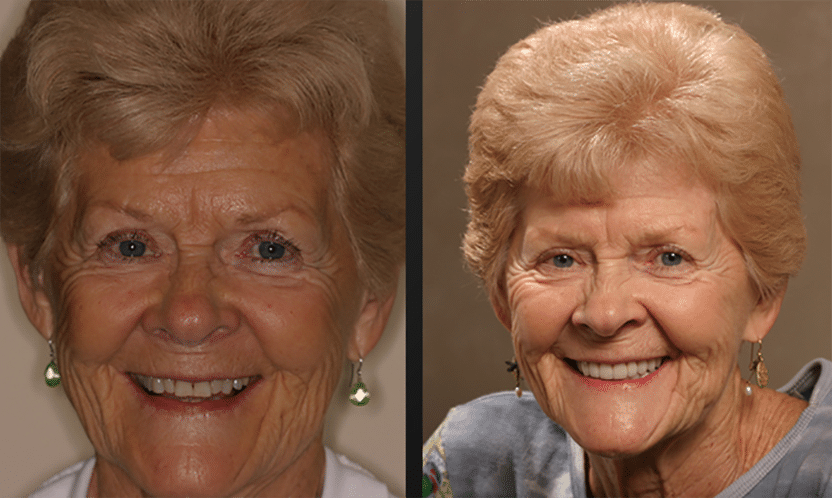 senior patient of Dr. Haddad showing before and after smiles