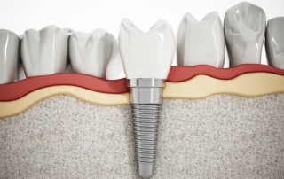 Digital illustration of a dental implant next to normal teeth
