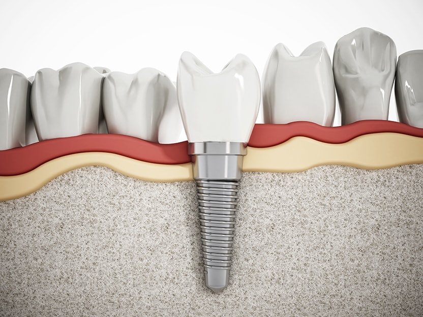 Difference between temporary and permanent dental implants