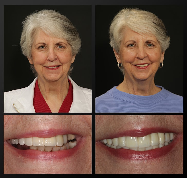 Smile Gallery Template – Haddad Sylvia-min Sylvia's portrait and smile close up before and after dental treatment