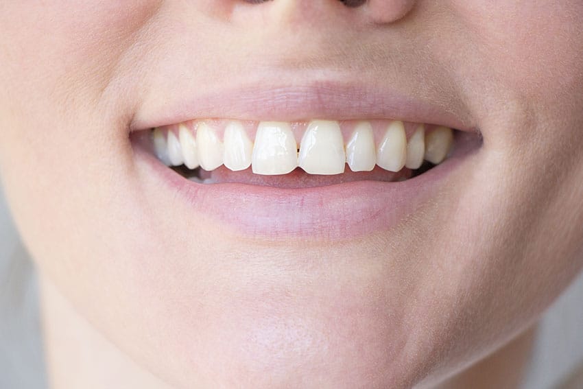 closeup of a female's smile with chipped teeth