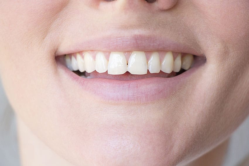 Common Causes of Chipped or Cracked Teeth My Dental Remedies