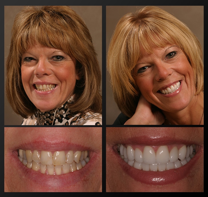 before and after comparison of patient with new, amazing smile