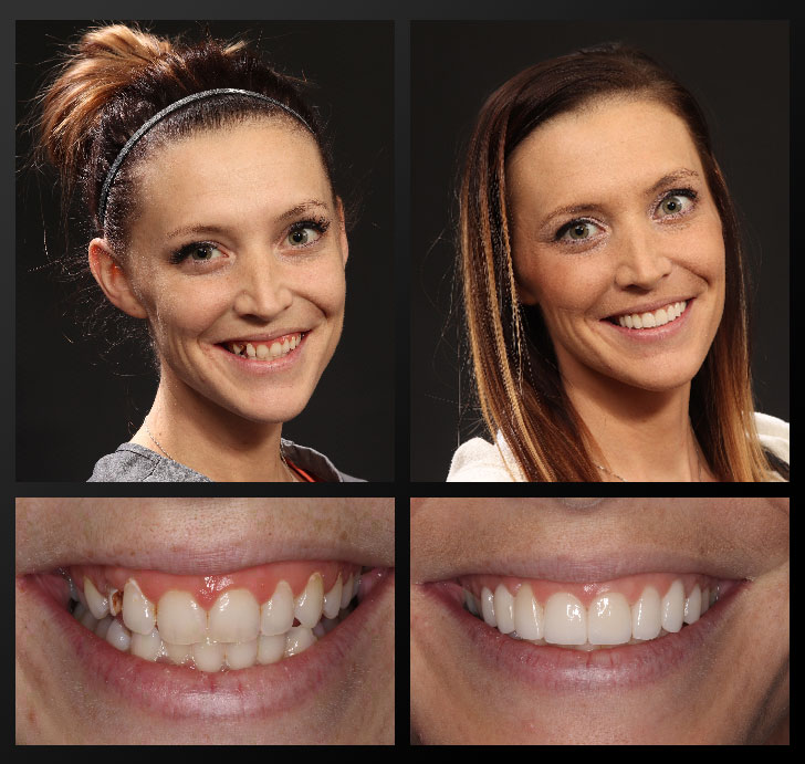 courtney-before-after smile gallery patient before after