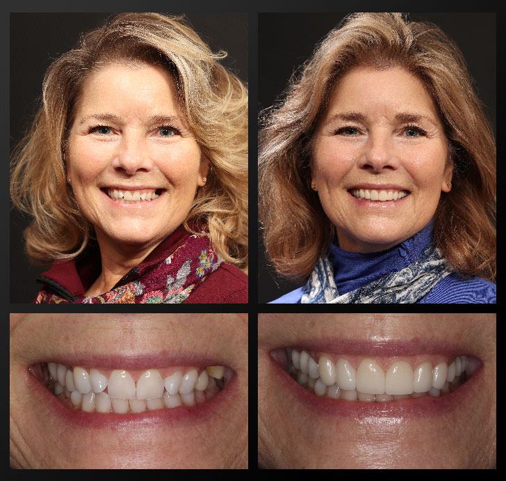 smile gallery patient before after