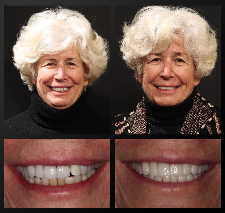 mary-ann-before-after smile gallery patient before after