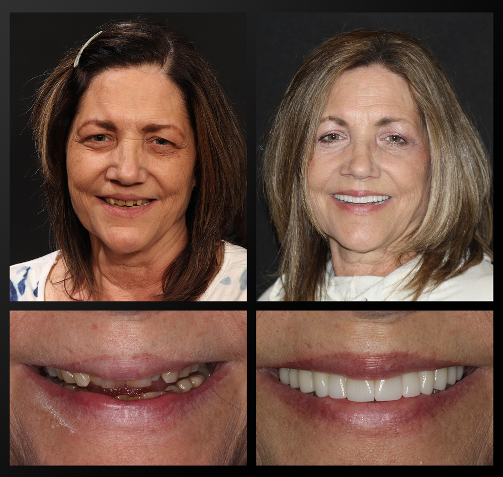 smile gallery patient before and after