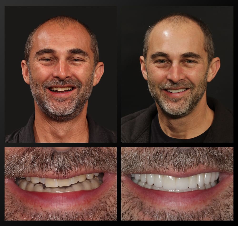 smile gallery patient before and after