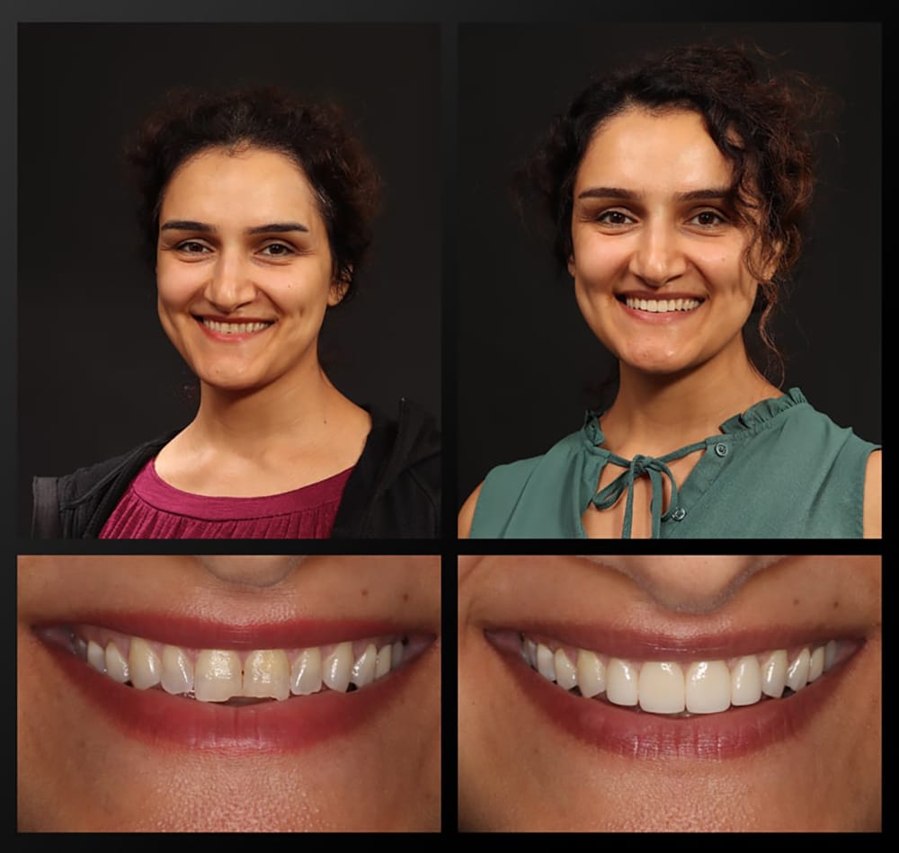 Haddad Patient Before and After Ana