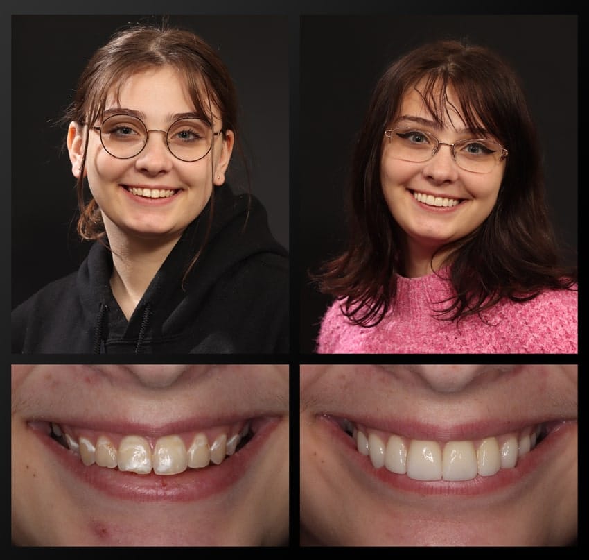 haddad patient before and after collage