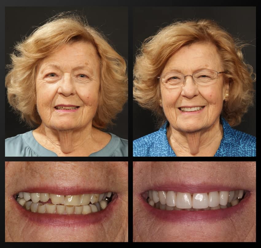 before and after collage of patient's smile