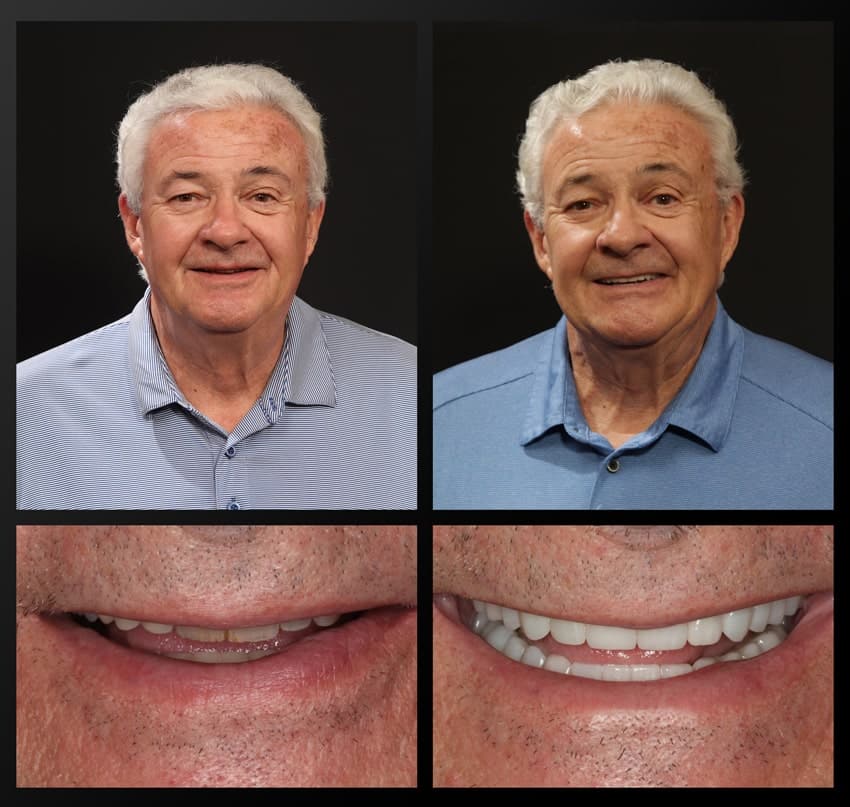 before and after collage of patient's smile